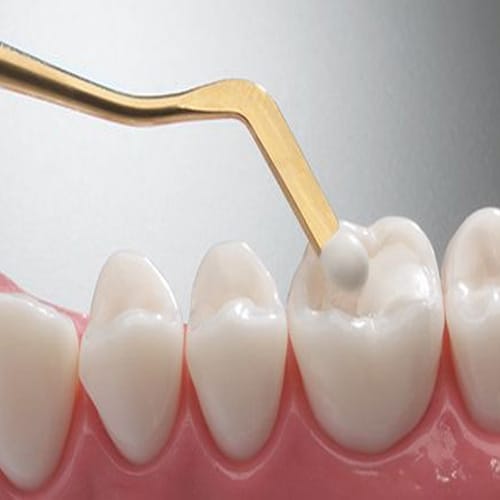 tooth Composite fillings