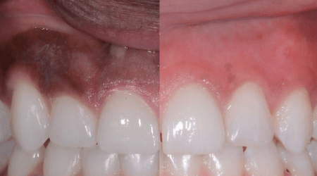 Gum depigmentation