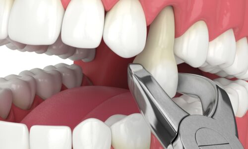 teeth extraction