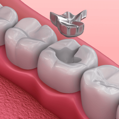 tooth silver amalgam