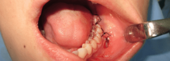 Incision teeth