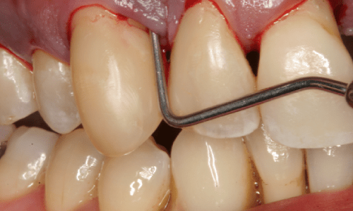 teeth flap surgery