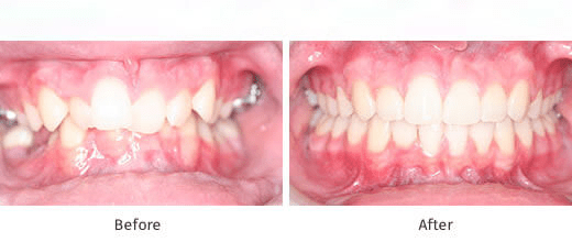 teeth crossbite