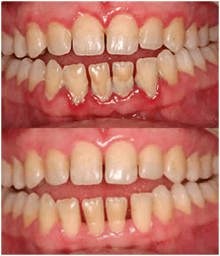 teeth gap