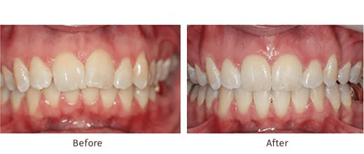teeth overbite