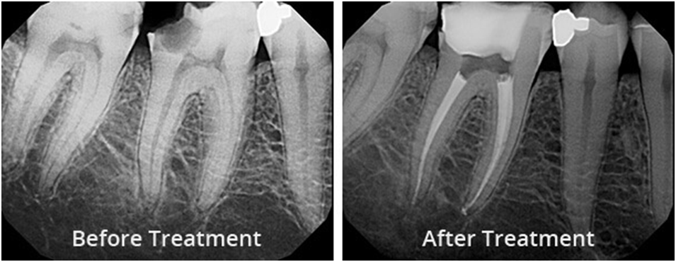 root canal treatment x ray
