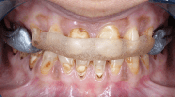 Full-Mouth-Dental-Rehabilitation