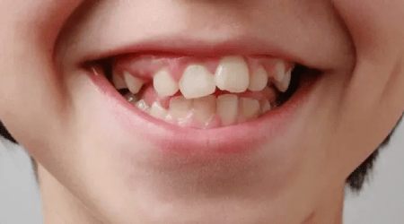 Misaligned crowded teeth