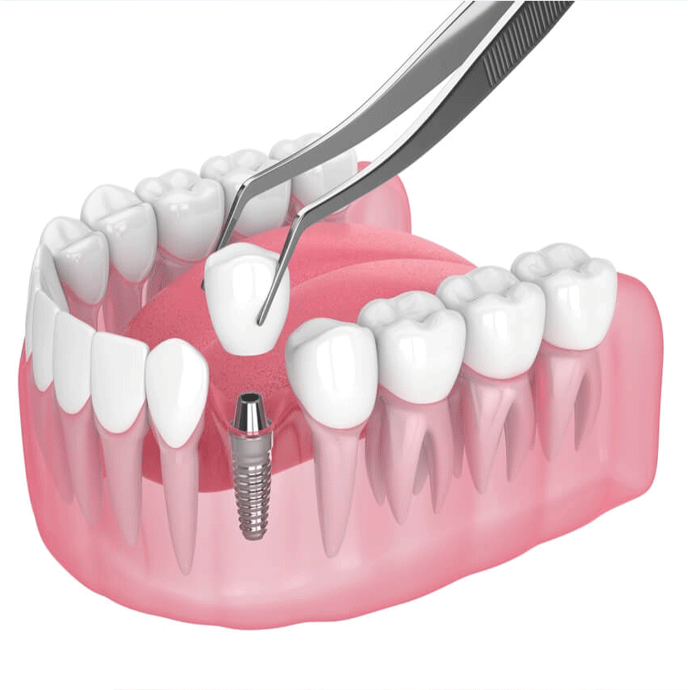 dental implants treatment process