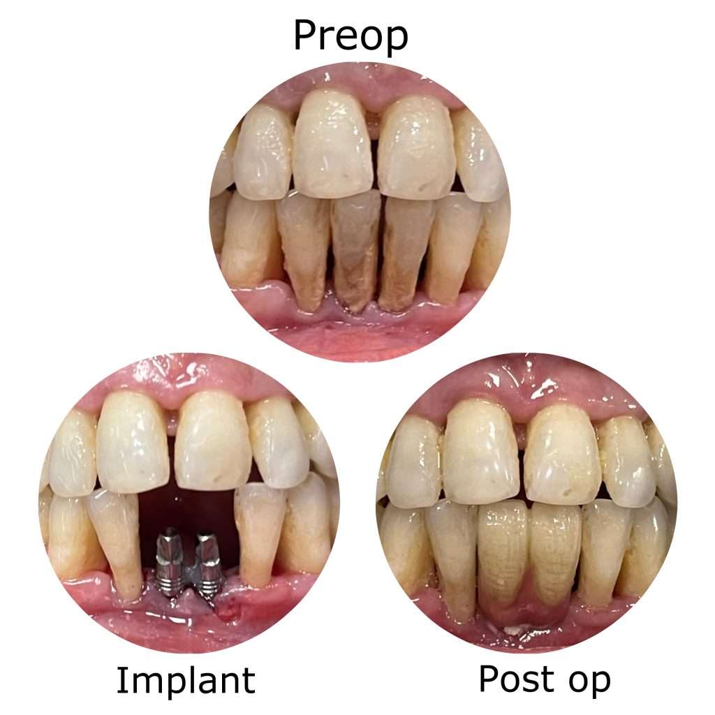 full mount dental implants