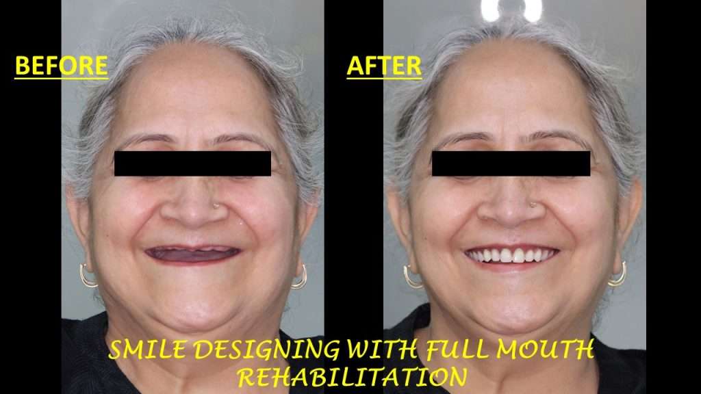 full mouth dental implants