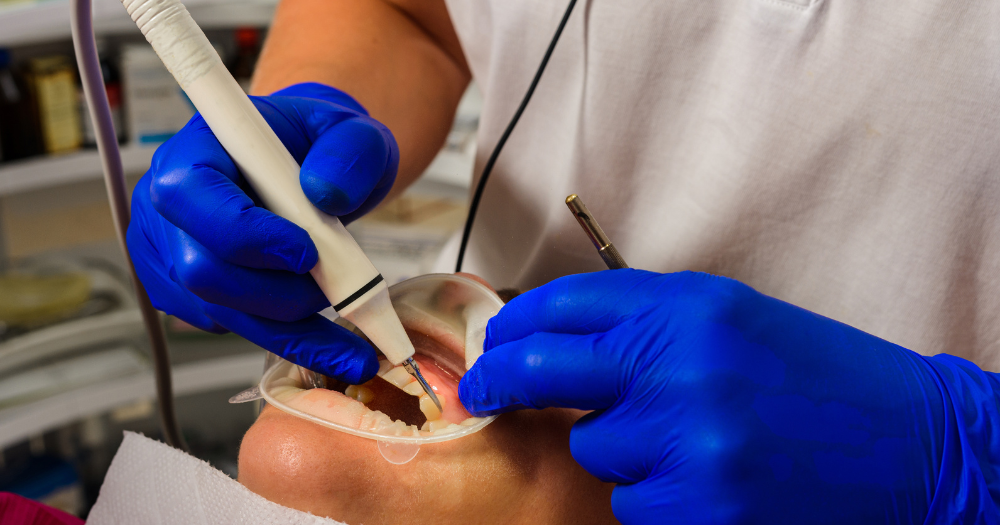 Is Tartar Removal Painful? Your Ultimate Guide to Dental Cleaning