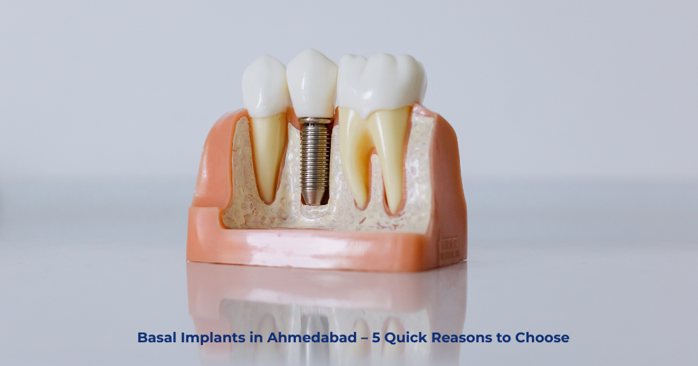 Basal Implants in Ahmedabad | Agrawal Dental Clinic
