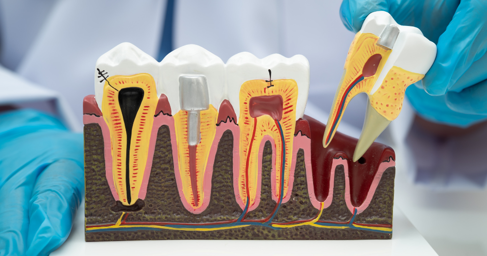 Which root canal cap is best for long-term protection