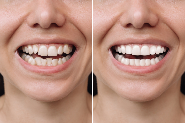 What Are the Top 5 Cosmetic Procedures for a Perfect Smile?